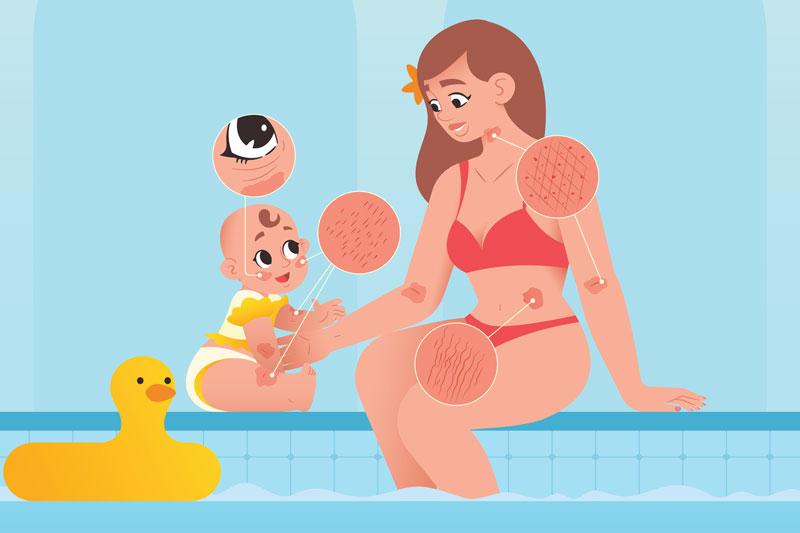 illustration - eczéma