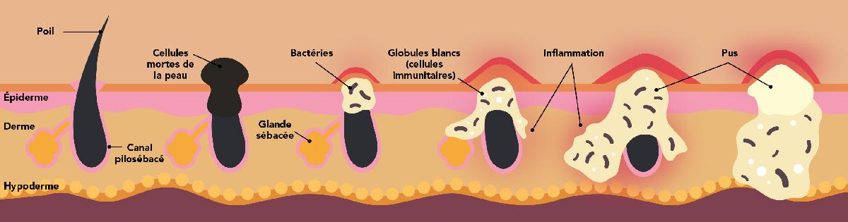 Évolution d’une lésion acnéique