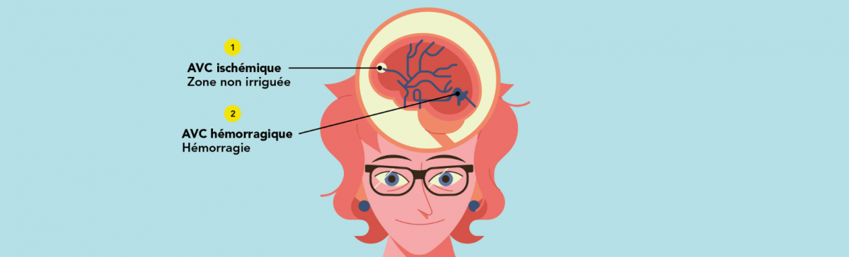 Accident vasculaire cérébral