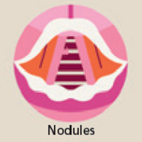 nodules