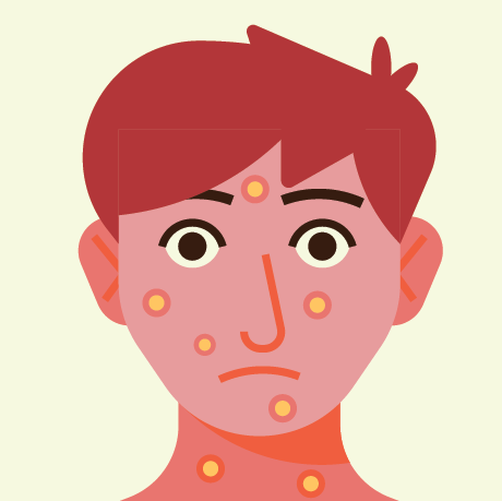 Signes d’une allergie