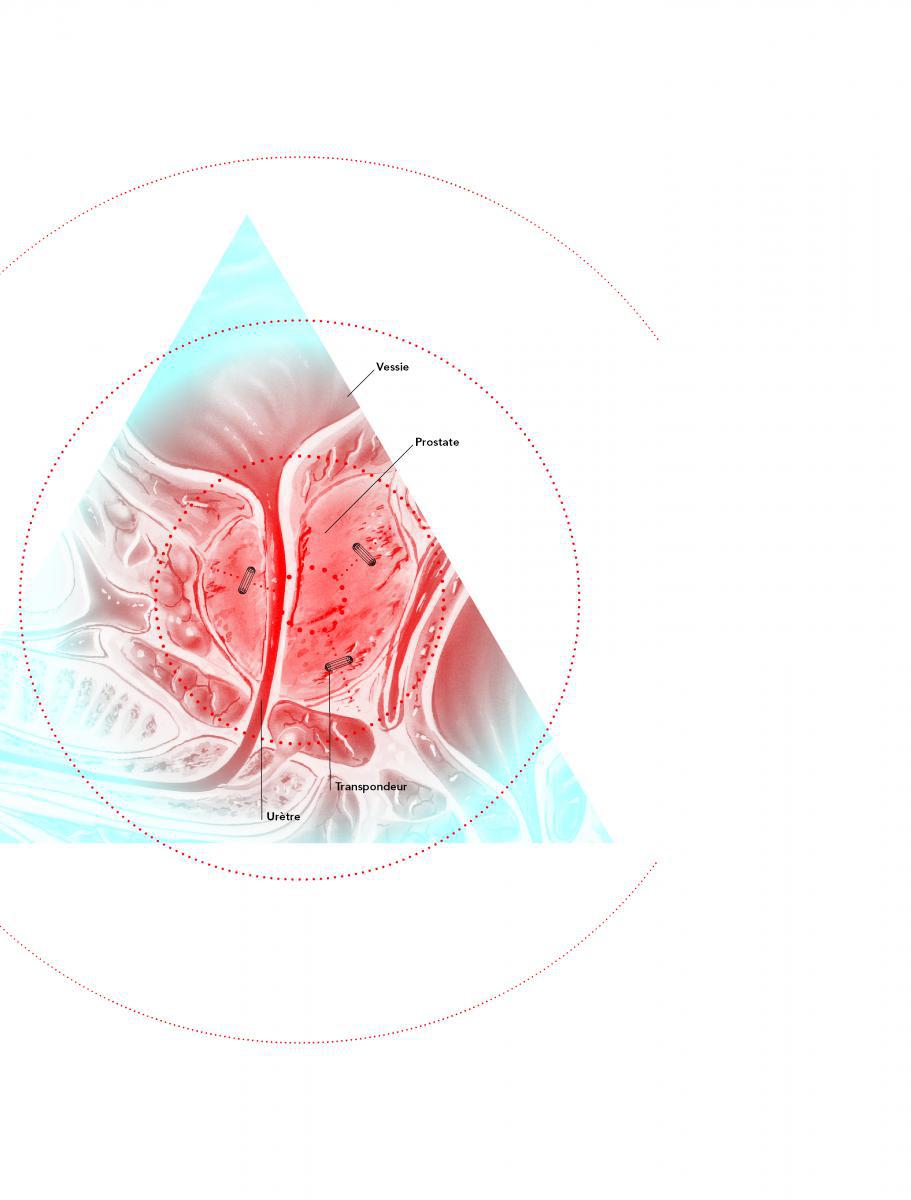 radiothérapie contre le cancer de la prostate