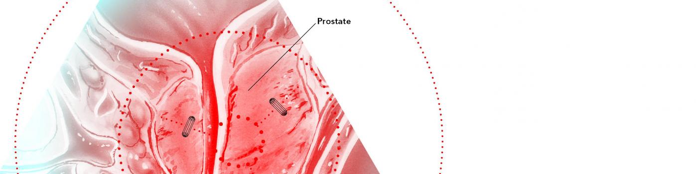 Radiothérapie contre le cancer de la prostate : un GPS révolutionnaire