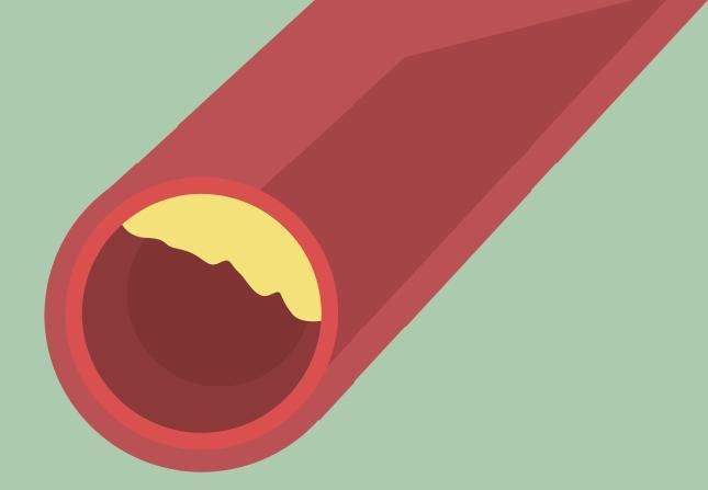 Début d’artériosclérose Début d’artériosclérose