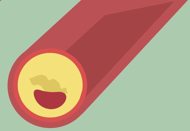 Obstruction de l’artère Obstruction de l’artère