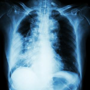 Radiothérapie pulmonaire guidée par GPS