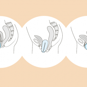 illustration descente d'organe