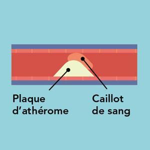 Formation d’un caillot de sang