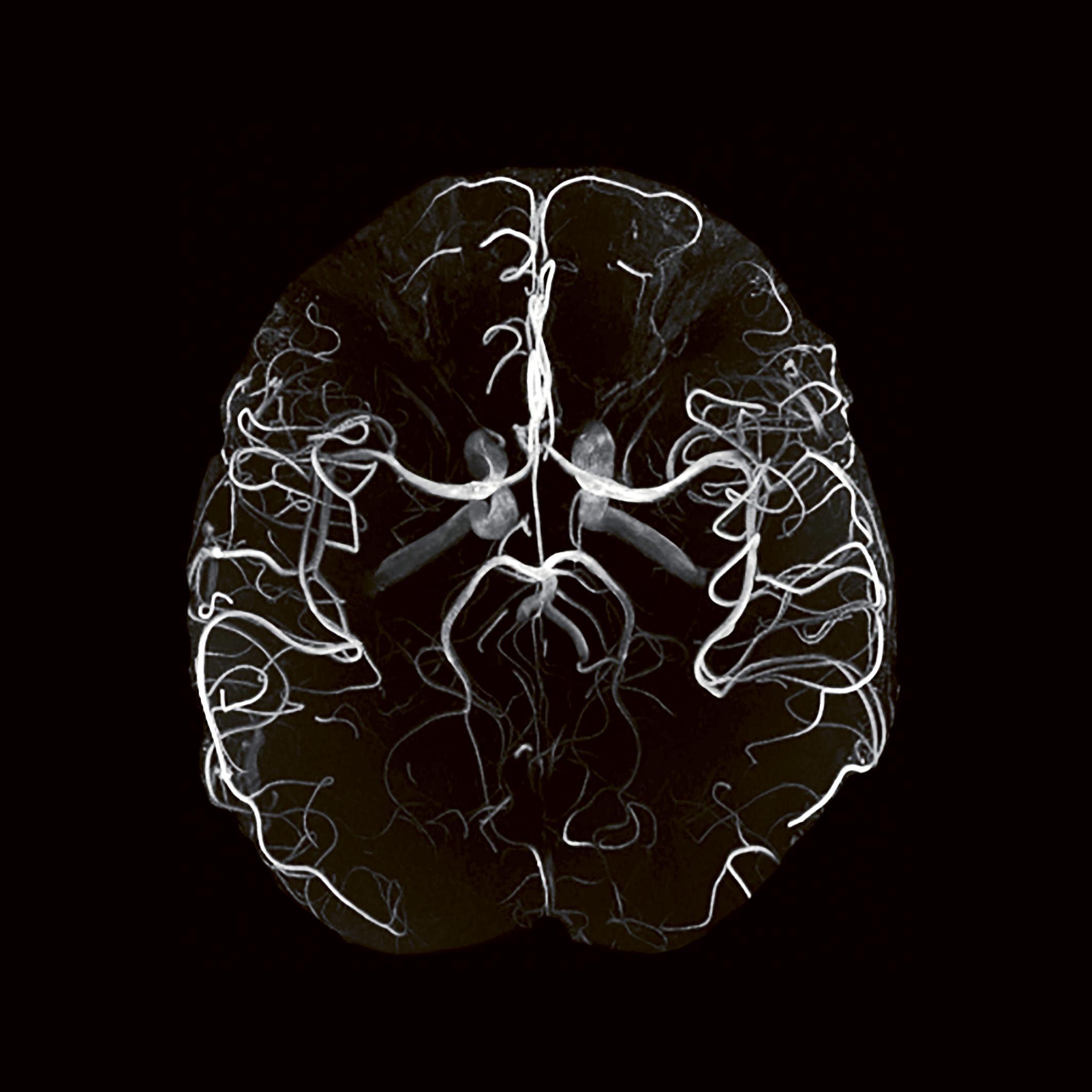 Angio-IRM montrant à haute résolution la vascularisation cérébrale. Angio-IRM montrant à haute résolution la vascularisation cérébrale.