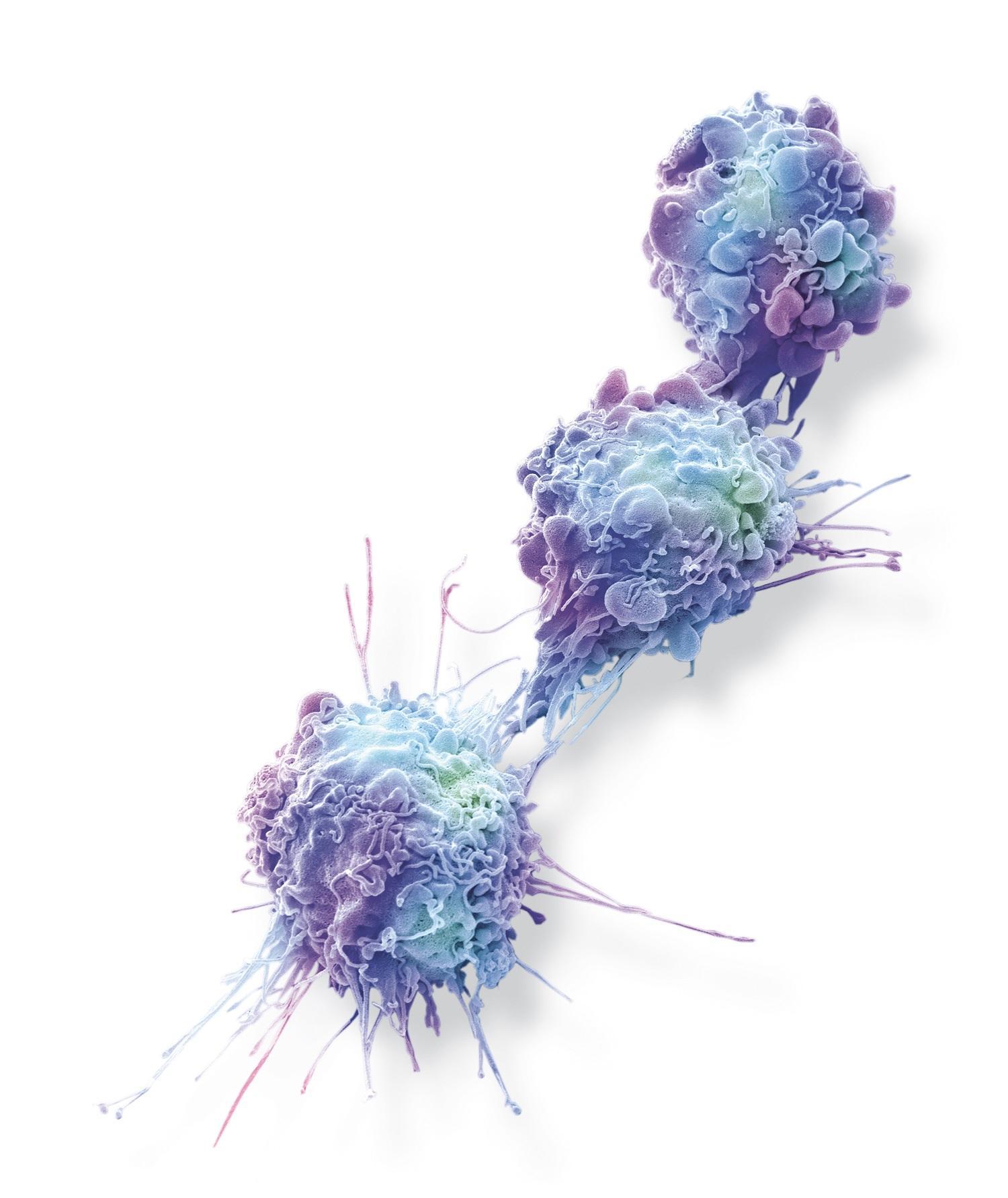 Cellules cancéreuses ovariennes (image grossie 10 000x). Cellules cancéreuses ovariennes (image grossie 10 000x).