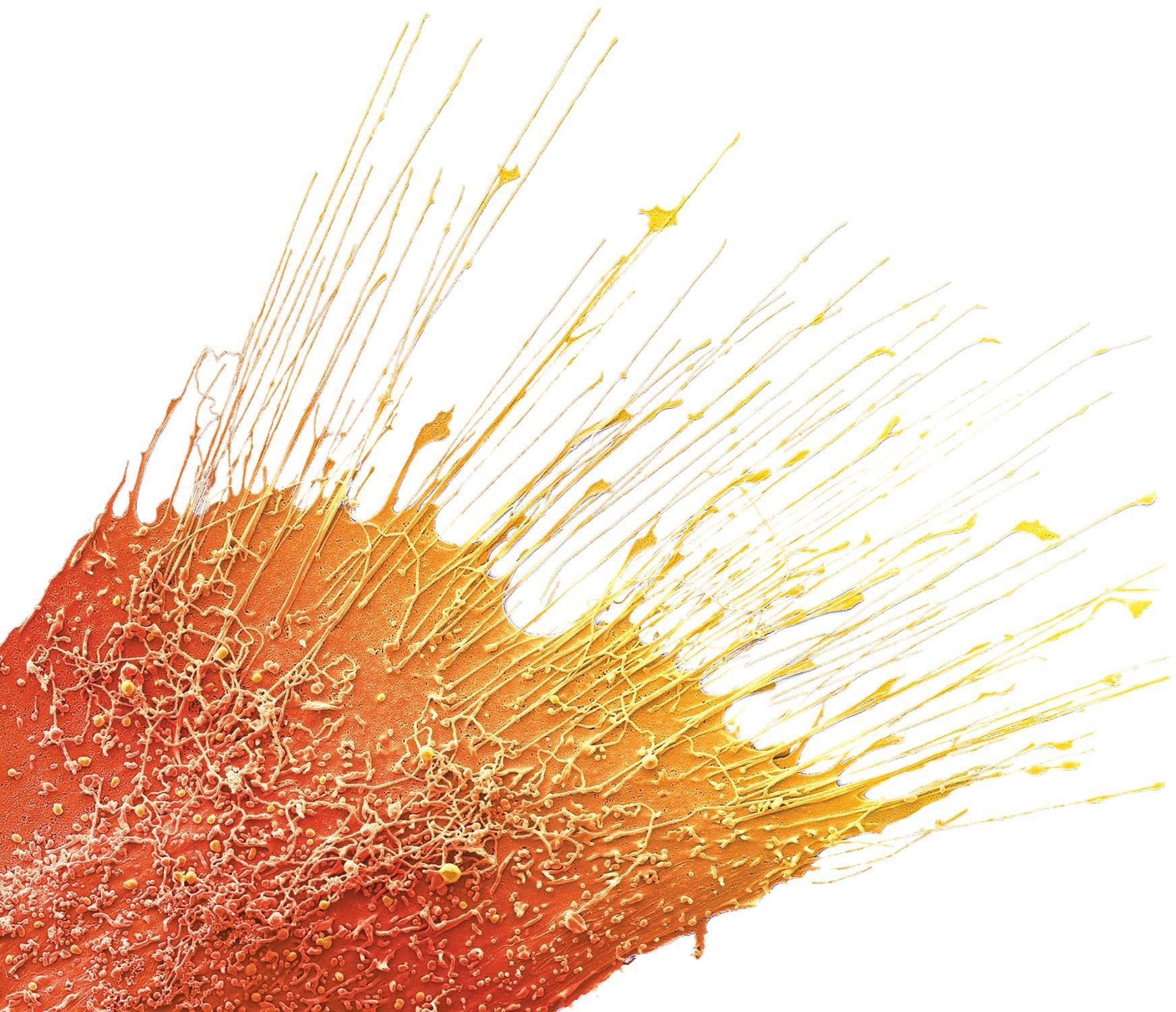 Cellules de cancer du sein cultivées sur une plaque de verre (image grossie 2920x). Cellules de cancer du sein cultivées sur une plaque de verre (image grossie 2920x).