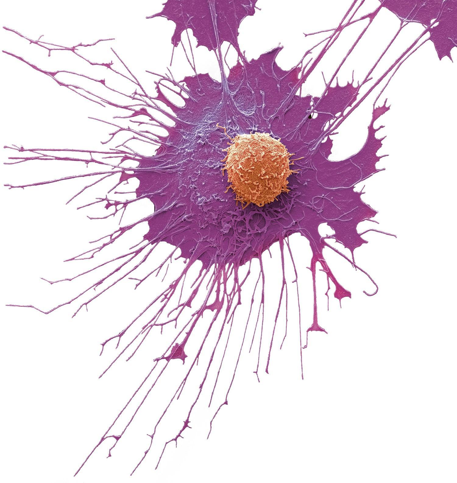 Cellule T (en orange) et cellule cancéreuse de la prostate (en violet). Les cellules T sont un composant du système immunitaire de l’organisme (image grossie 6000x). Cellule T (en orange) et cellule cancéreuse de la prostate (en violet). Les cellules T sont un composant du système immunitaire de l’organisme (image grossie 6000x).
