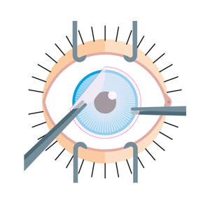 Pose du patch sur la cornée et la conjonctive Pose du patch sur la cornée et la conjonctive