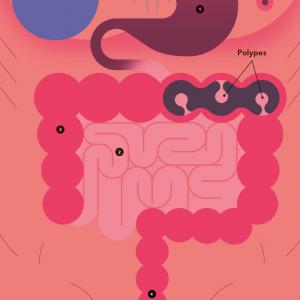 Cancer du côlon Cancer du côlon