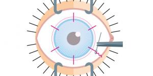 Des patchs de membrane amniotique pour réparer les cornées