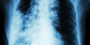 Radiothérapie pulmonaire guidée par GPS